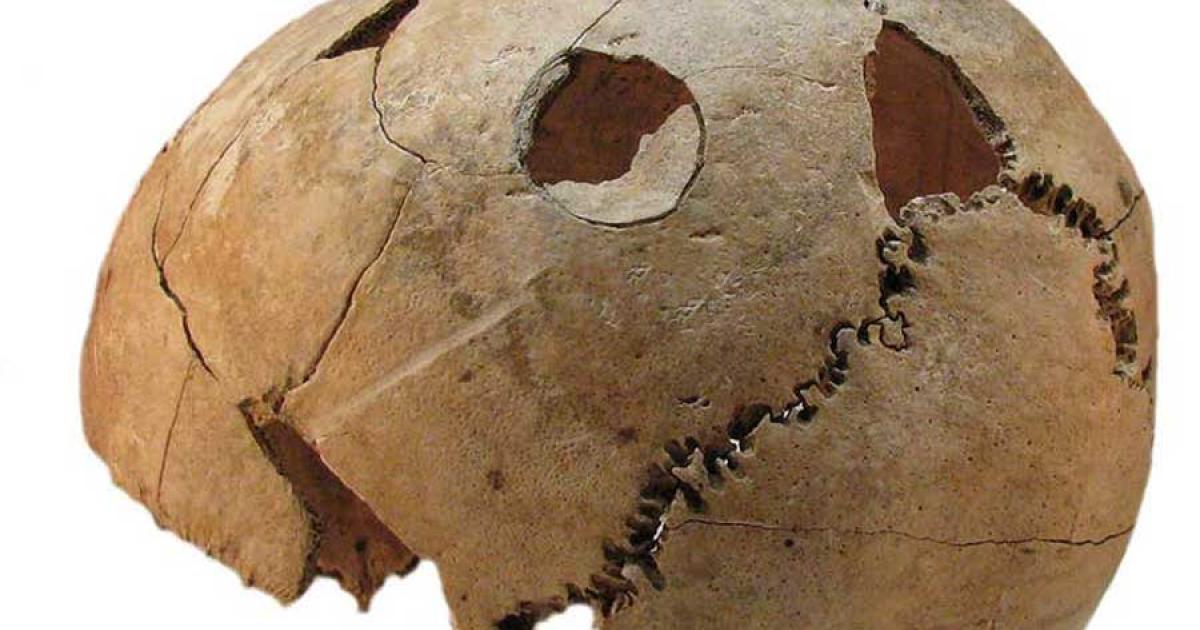 This skull from a teen boy, found at the Croatian massacre site, clearly shows blunt force injuries in two locations.