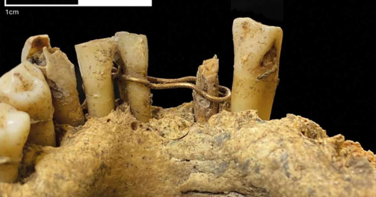 Gold wire ligature on the mandible of the medieval man found at St Nicholas Kirk, Aberdeen