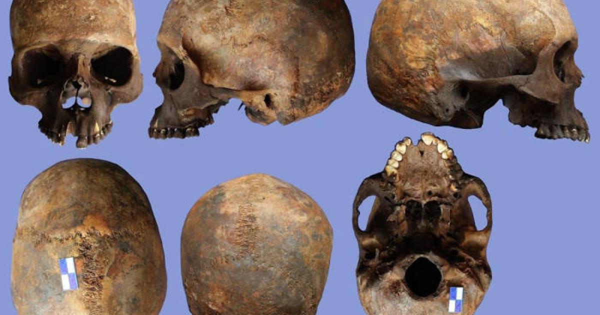Skull 2N showing evidence of rare Apert syndrome.