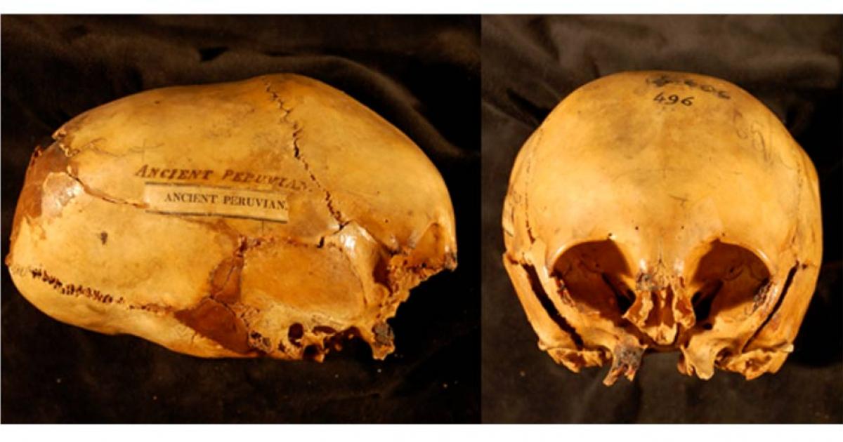 Elongated Skulls in utero - Morton Collection