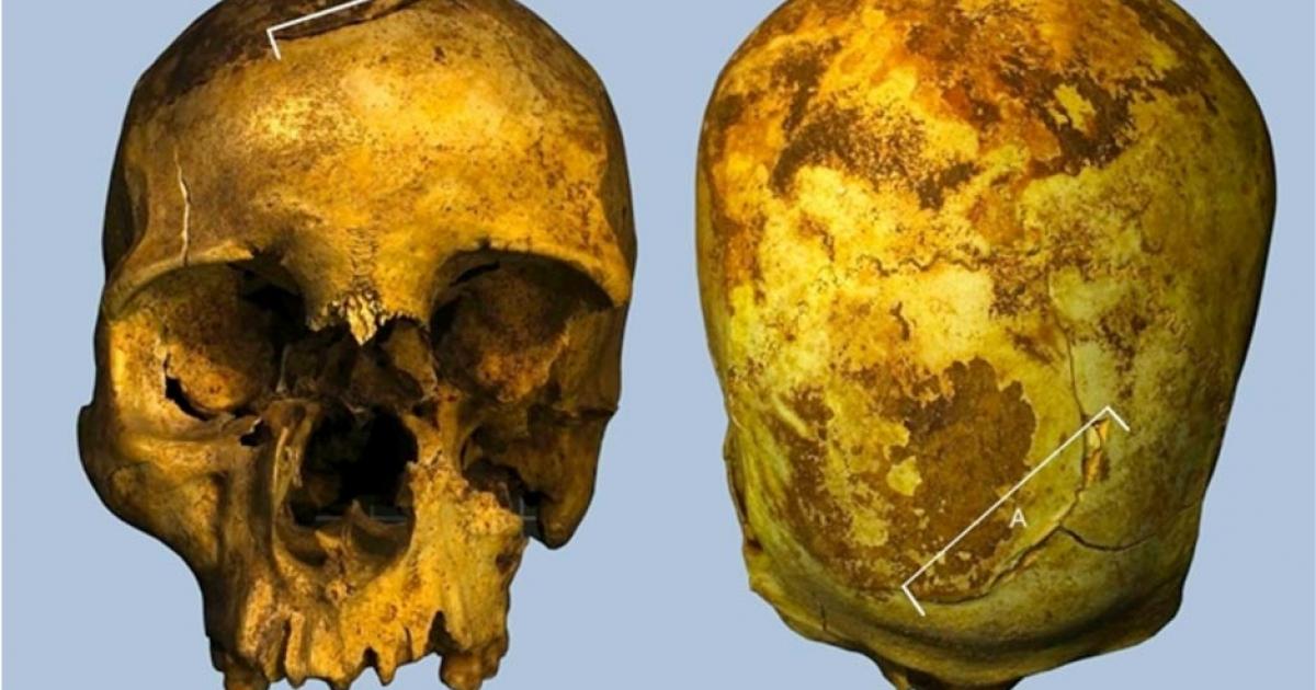 Fatal wounds to the front and back of the skull thought to be caused by axe blows.