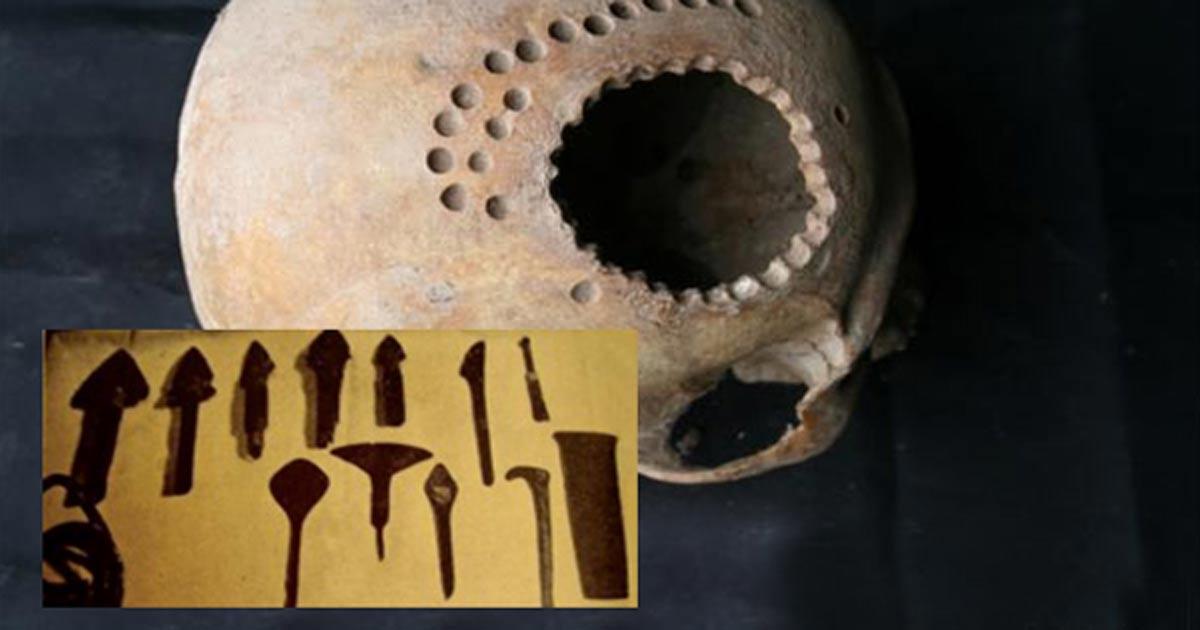 Main: An ancient skull found in Peru with evidence of surgical intervention. Credit: Danielle Kurin. Inset: 4,000-year-old “scalpels” 