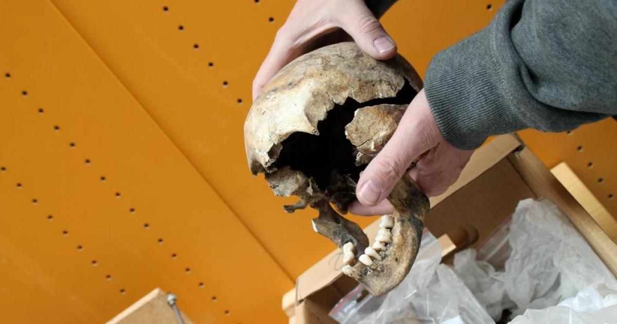 The skull of a young girl who suffered from syphilis; she would have been a candidate for treatment with mercury in the Middle Ages.