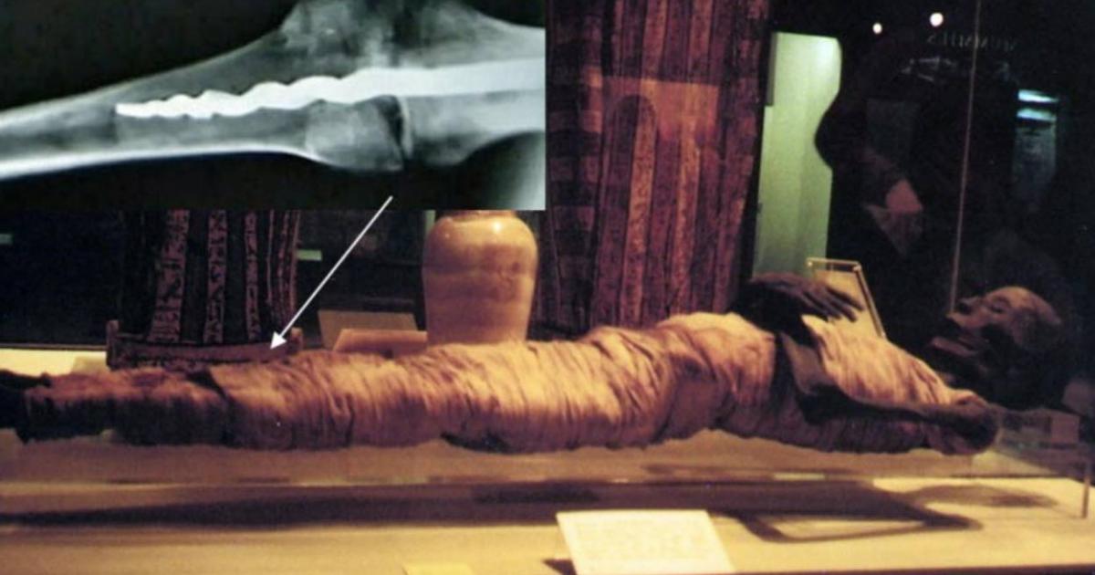 Usermontu's Knee Screw Baffles Experts: 2,600-Year-Old Medical Marvel 