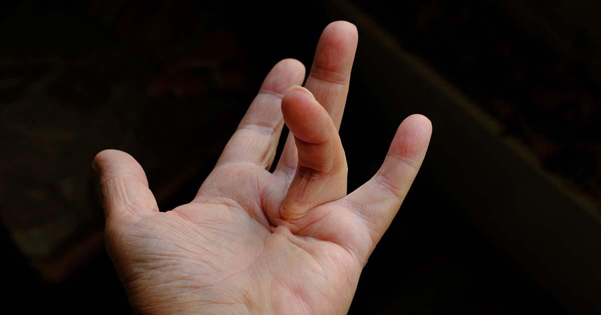 The hand of a person with Viking’s disease, a.k.a. Dupuytren’s contracture, a condition of the hand that can cause some of a person’s fingers to become permanently bent at an angle. Source: Artwell / Adobe Stock 