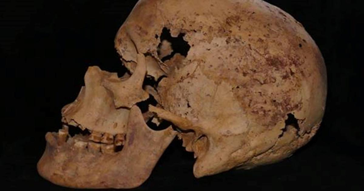 Skull exhibiting evidence of cancer. Source Egyptian Ministry of Antiquities