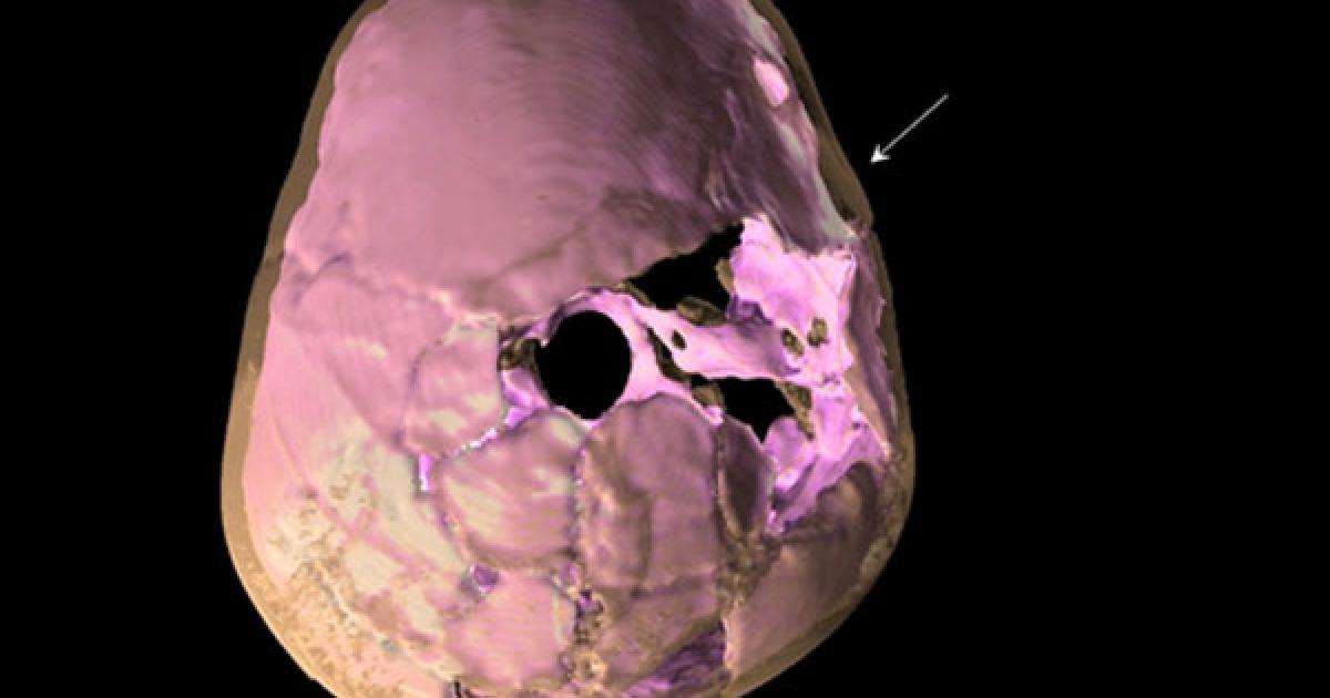 Brain-damaged child 100,000 years old