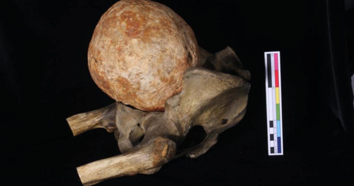 The calcified uterus resting in the pelvic bone of a skeleton. 