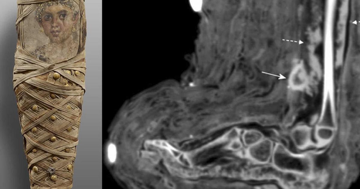 On the left, photograph of ancient Egyptian child mummy from Tomb of Aline, discovered in Hawara. On the right, CT scan of soft tissue infection in the lower leg, showing a mass consistent with dried pus. Source: Panzer et. al / International Journal of Paleopathology