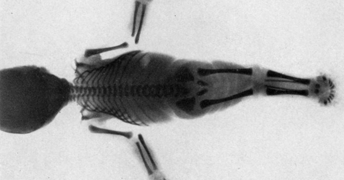 Are Mermaid Myths Inspired by a Rare Medical Condition?