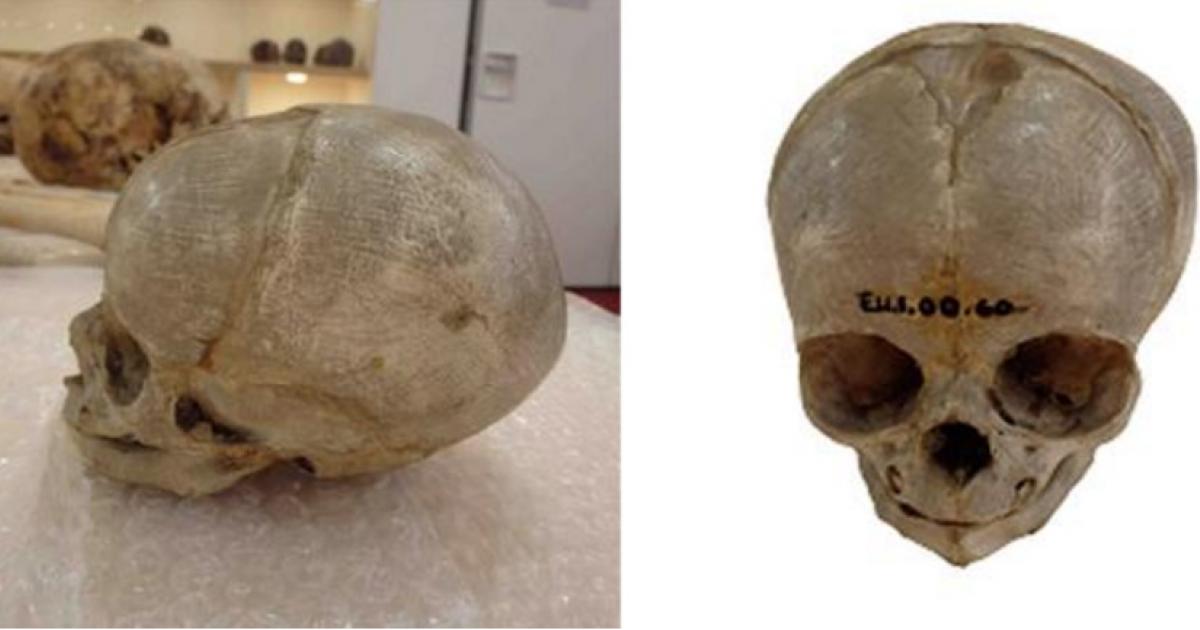 issected foetal skull dating from the 1800s, originally held in the University of Cambridge Anatomy Museum.