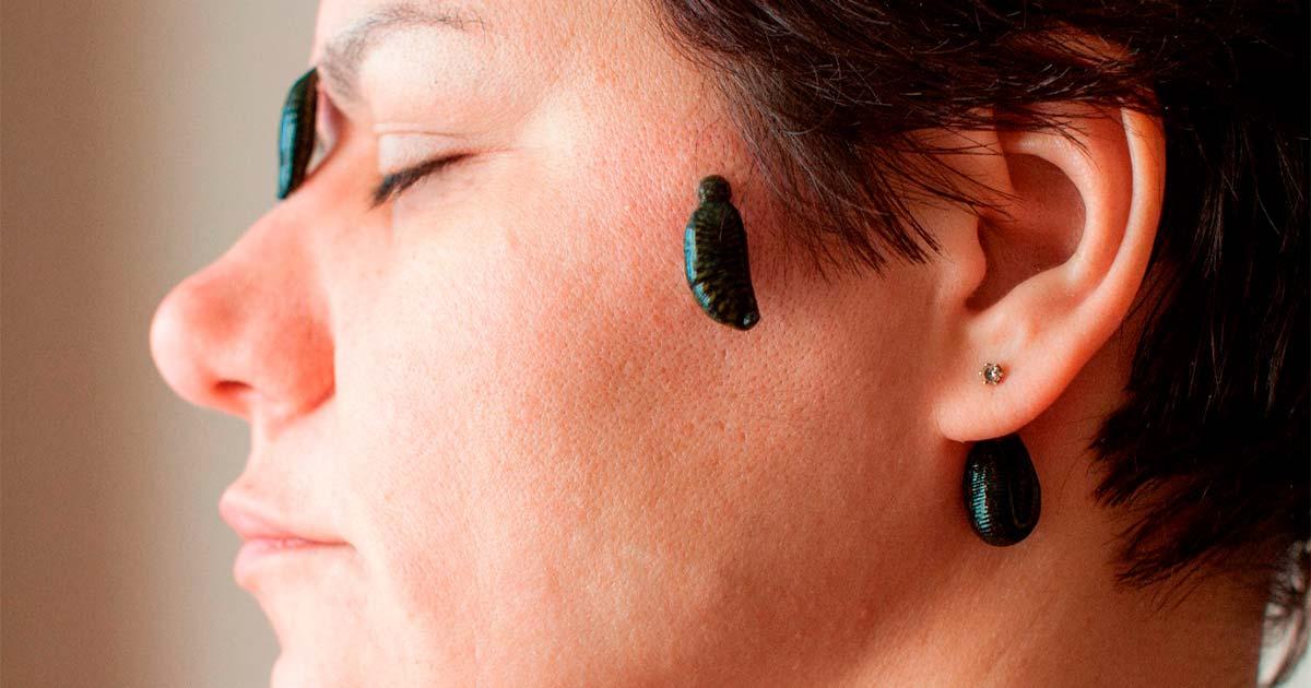 Leech therapy. Source: Natalia Terenteva / Adobe Stock