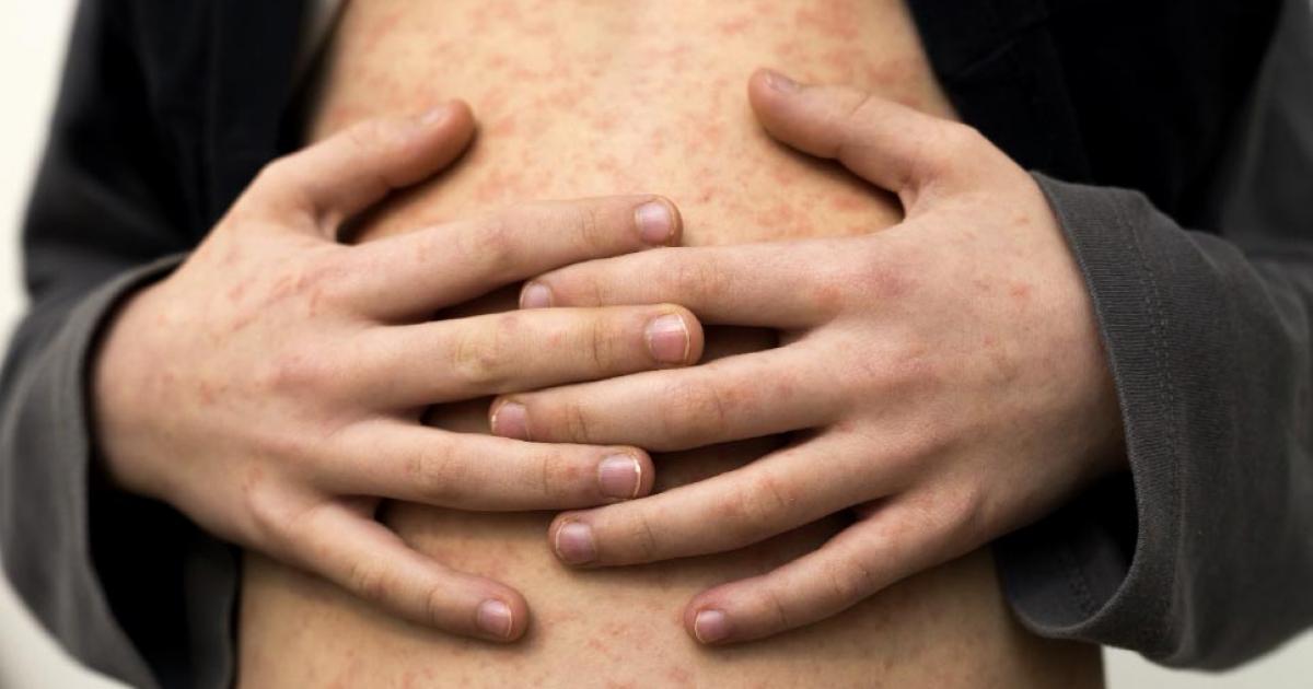 A boy with the measles. Credit: bilanol / Adobe Stock