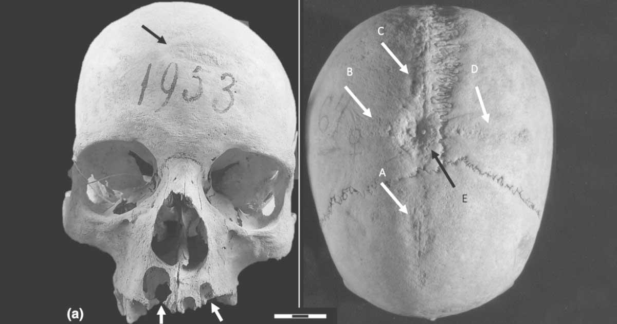 Skull of a medieval woman showing evidence of brain surgery. Source: Divulgação/Universidade Sapienza