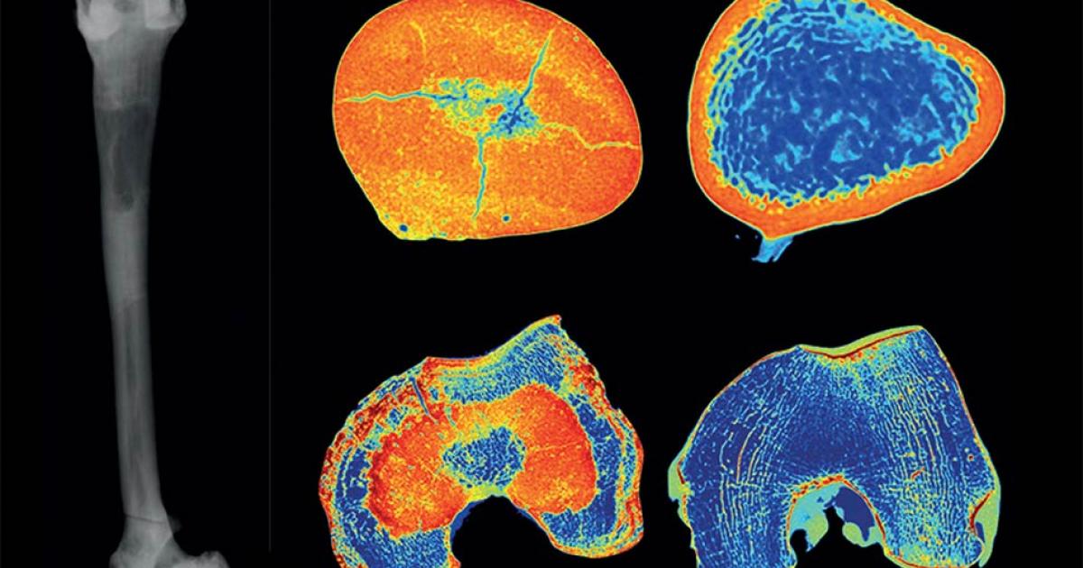 Neolithic Maliq Man Had Oldest Known Case of Osteopetrosis
