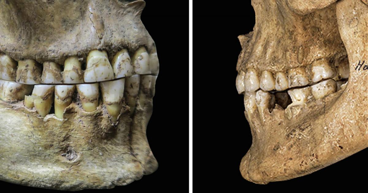 An ancient woman from Romania shows an edgeto-edge bite (left). A Bronze Age man from Austria had a slight overbite (right). Source: D. E. Blasi et. al. / Science 