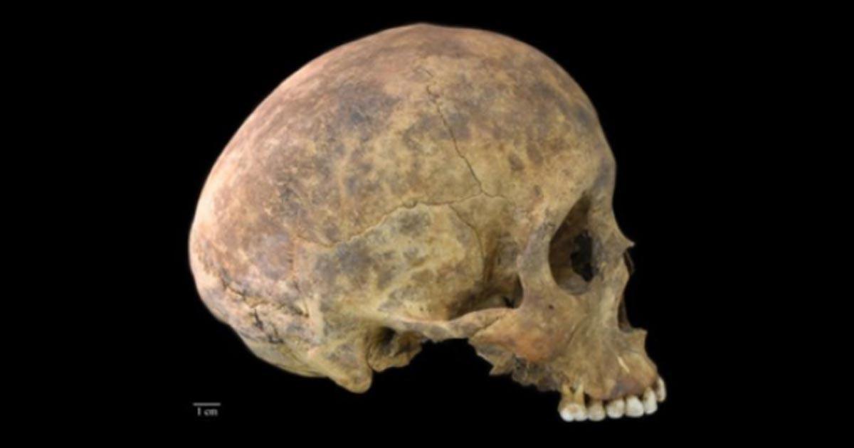 One of two cases of healed blows to the cranium from the Playa Venado excavations. 	Source: Nicole Smith-Guzmán, STRI