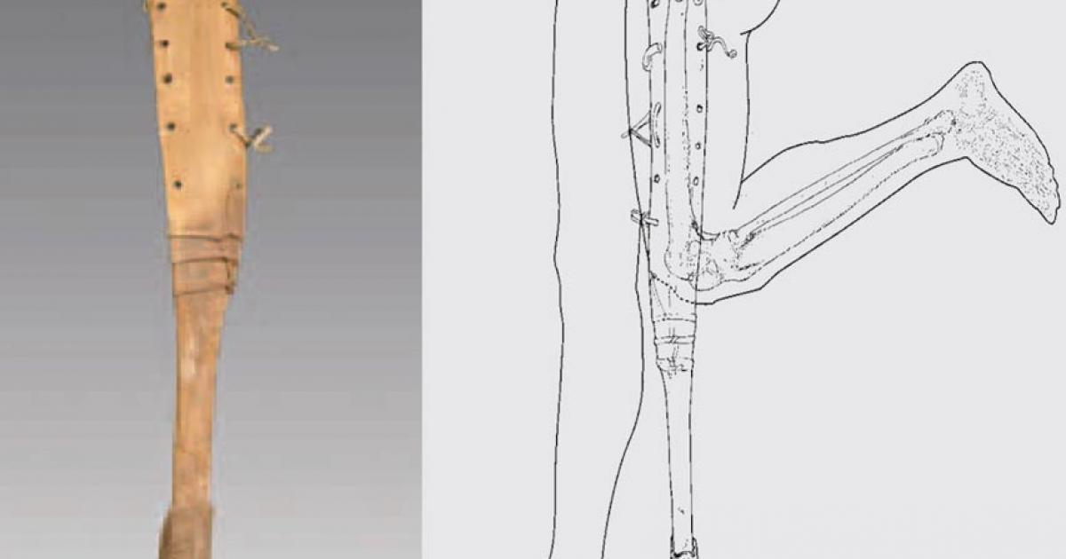 The prosthesis of the man with a fused knee, femur and tibia helped him walked, which would have been difficult for him otherwise. 