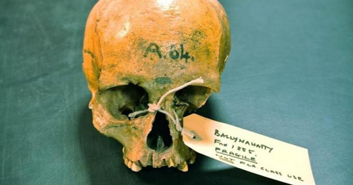 The skull of the Neolithic woman excavated in 1855 in Ballynahatty, Northern Ireland. 