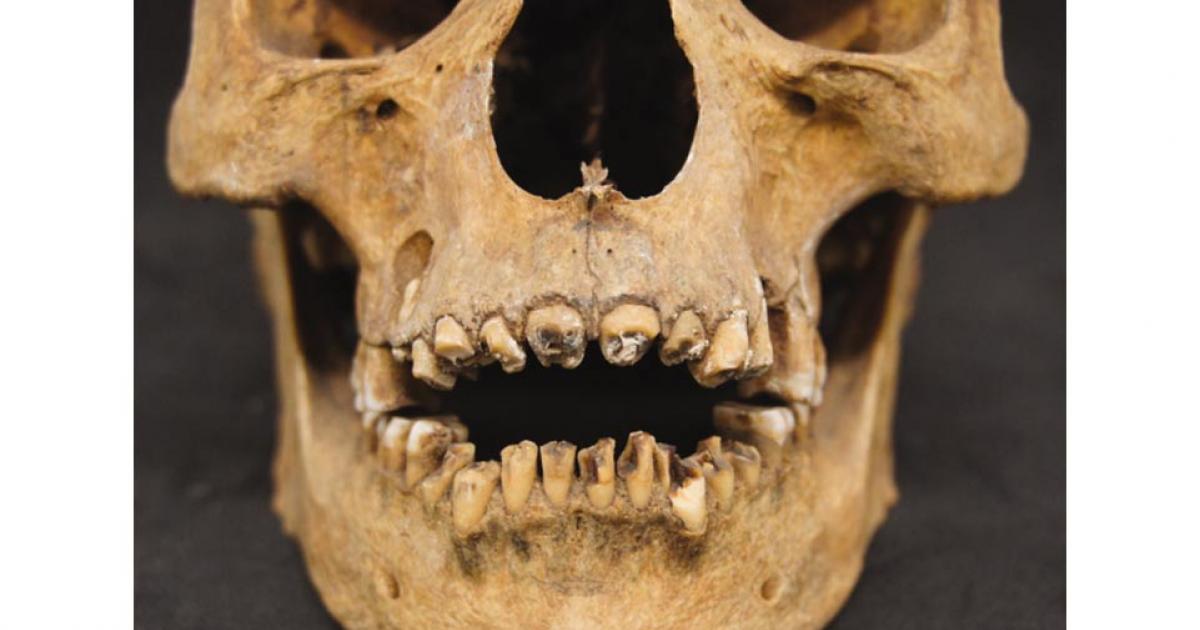 The teeth of a 17th dynasty (circa 1550 BC) mummy had his teeth broken out, probably during the embalming process. This mummy's wrappings were removed in the early 20th century. 