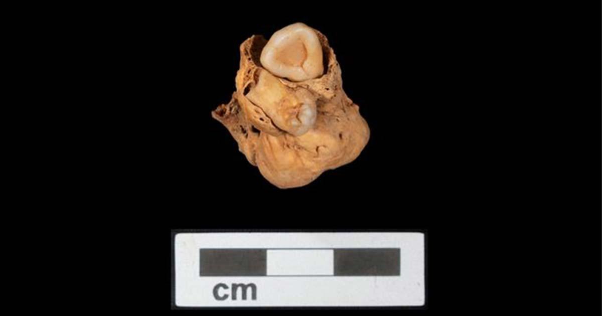 The teratoma tumor, including teeth, which was discovered within the Amarna crypt. Source: A. Deblauwe / Amarna Project