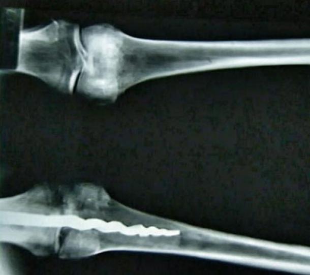 X-ray showing the 9-inch drill in the knee of Usermontu.