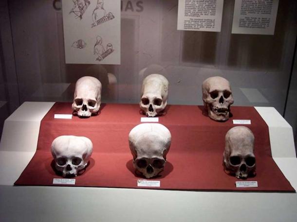 A case of skulls from the Andean Paracas culture, as seen in the Museo Nacional de Arqueología, Antropología e Historia del Perú in Lima. They illustrate head flattening practiced in this culture's elite.