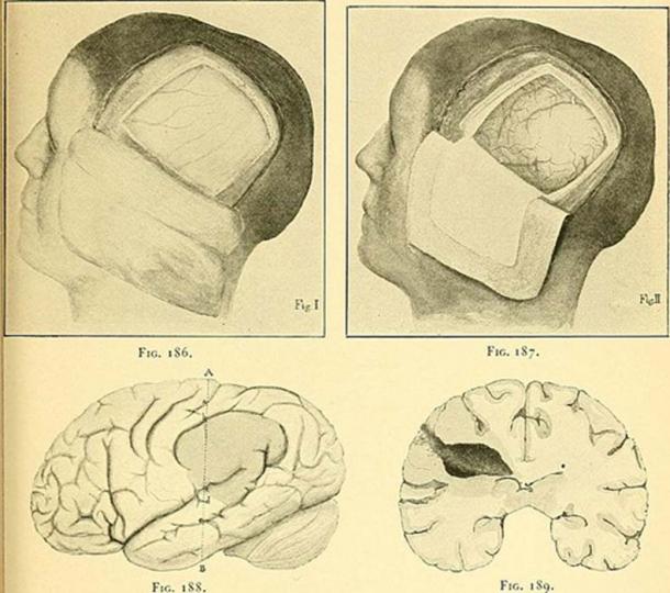 A craniotomy removes some of the skull to allow access to the brain, or to give the brain space to swell. (Internet Archive Book Images)