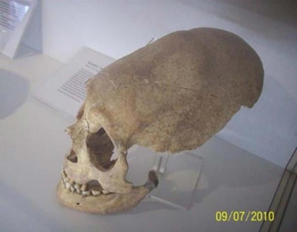 An elongated skull found in Germany. (soul-guidance.com)
