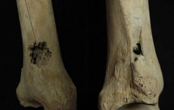 First Ever Evidence for Ancient Bone Surgery found in Peru - Holes Drilled in Legs