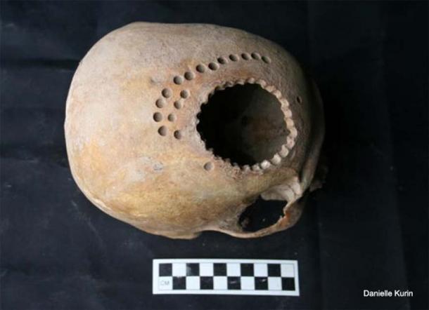 Ancient cranial surgery in Peru