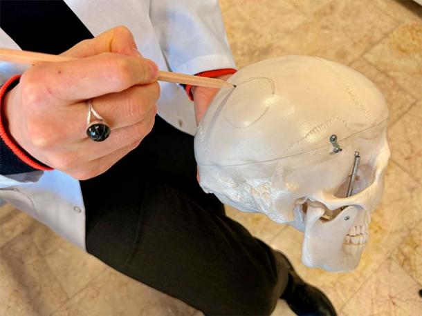 Archaeologists analyzing skeletal remains found at Çatalhöyük found evidence of trepanation surgery. (Anadolu Agency)