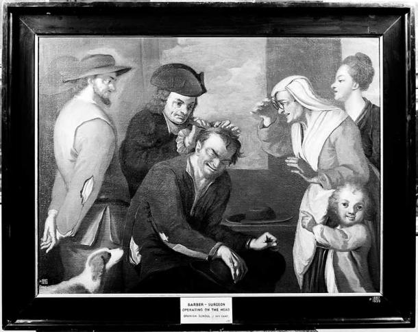 Barber surgeons were really just early doctors that took care of hair and also performed weird procedures, like bloodletting. However, these “surgeons” were necessary to deal with all the “odd emergencies” of medieval life. This barber surgeon is operating on a man’s head. (Wellcome Images / CC BY 4.0)