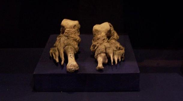 Bones from the feet of a leper, clearly deformed by the illness. Denmark. Representational image.