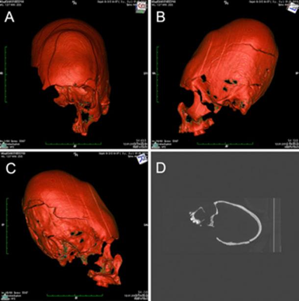 CT reconstruction showing one of the elongated skulls exhibits a depressed and strongly inclined frontal bone, indicating tabular oblique type of deformation. (M Kavka / CC BY 4.0)