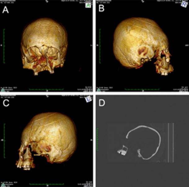 CT scans of the so-called circular-erect type cranial deformation. (M Kavka / CC BY 4.0)
