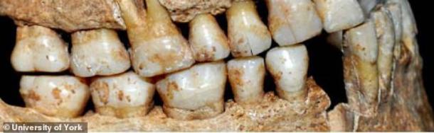 Calculus on the teeth of this skeleton revealed traces of an ancient cure. Credit: University of York