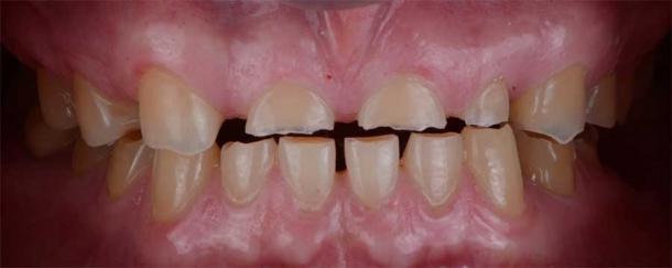 Los dientes humanos astillados y desgastados o los dientes de primates pueden decirnos mucho sobre lo que comió el individuo o la especie en cuestión y cómo afectó sus dientes. (Titinon / Adobe Stock)