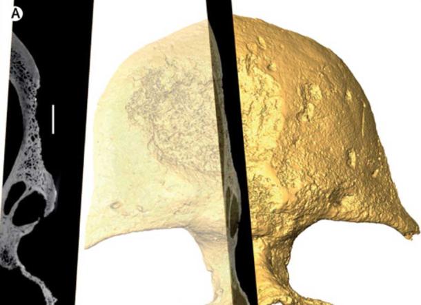 Detail of the bone erosion at the micro CT examination; bar is 0·5 cm. (Charlier et al. 2018)