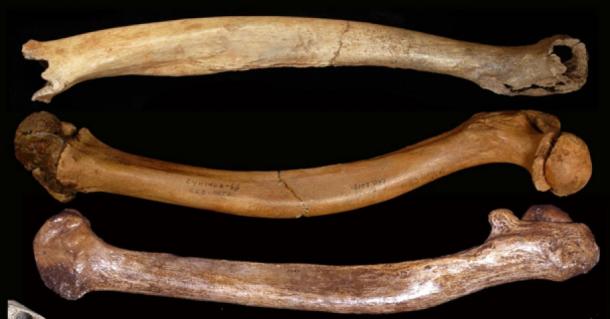 Skeletal abnormalities of development in Pleistocene people: Tianyuan 1, Sunghir 3 and Dolní V stonice 15 abnormal femurs. (Erik Trinkaus)