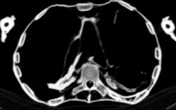 CT scans reveal the Egyptian princess died of a massive heart attack. The results show she suffered from a severe case of atherosclerosis that affected a number of her arteries