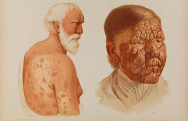 Elderly male with leprosy from 1889. (Fæ / CC BY-SA 4.0)