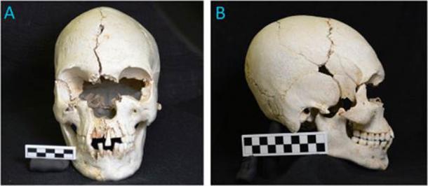 Evidence of leprosy in the nasal area of the Caribbean skull found on the uninhabited island of Petite Mustique and used in the recent study. (International Journal of Paleopathology)