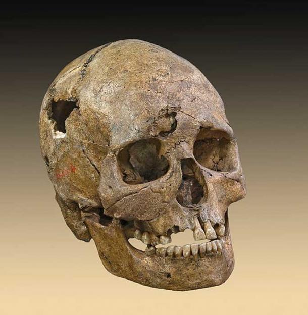 Exhibit A? Skull from the Téviec burial. This female died when she was 25 to 35 years old from a violent death with numerous skull fractures and bone lesions associated with the impact of an arrow.