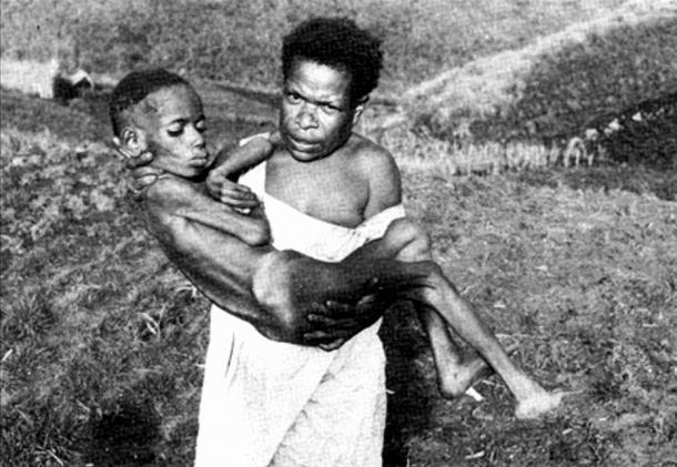 A Fore tribeswoman carrying a child with kuru disease 