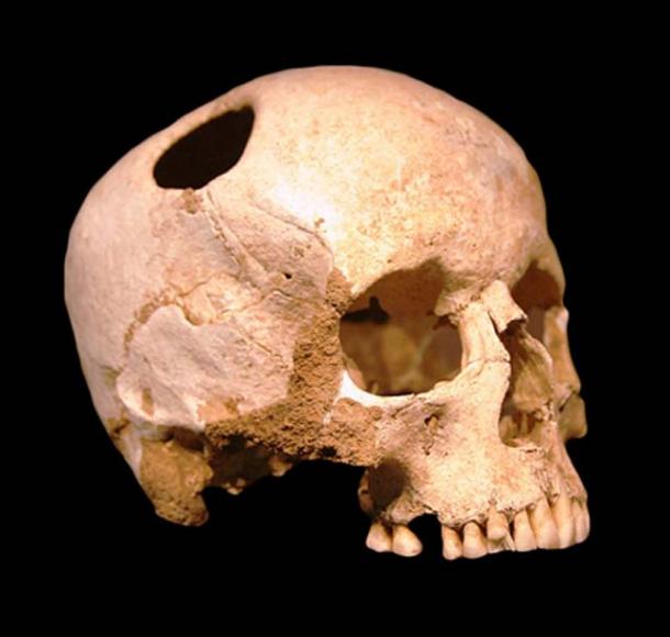 Girl skull, trepanated with a silex; neolithic (3500 BC); patient survived. Natural History Museum, Lausanne.