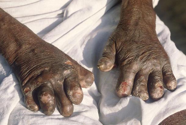 Hands deformed by leprosy. (B.jehle / CC BY-SA 3.0)