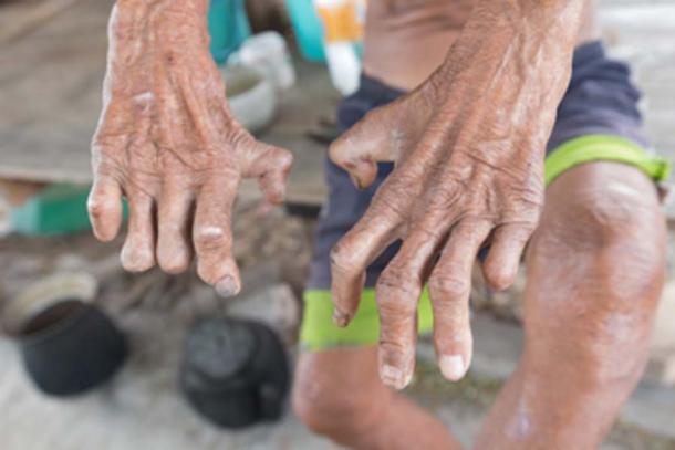 Hansen's disease, closeup of the hands of old man suffering from leprosy. (frank29052515 / Adobe Stock)
