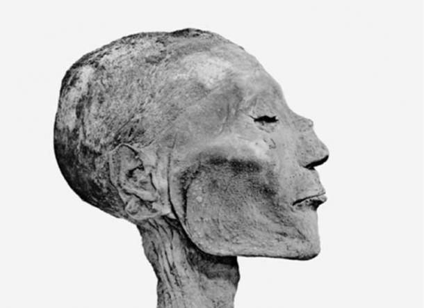 Head of mummy of pharaoh Rameses V shows bumps suggesting he died of smallpox.