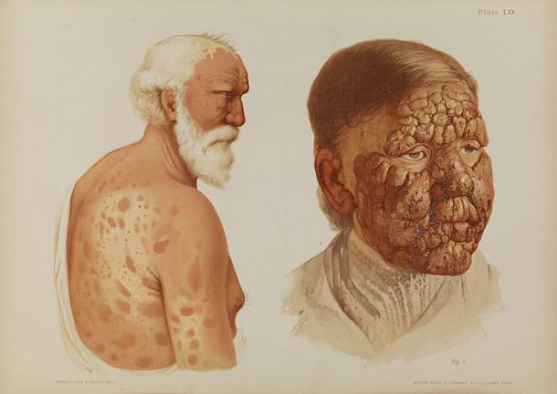 Illustration of elderly male patient with leprosy in 1889. (Wellcome / CC BY 4.0)